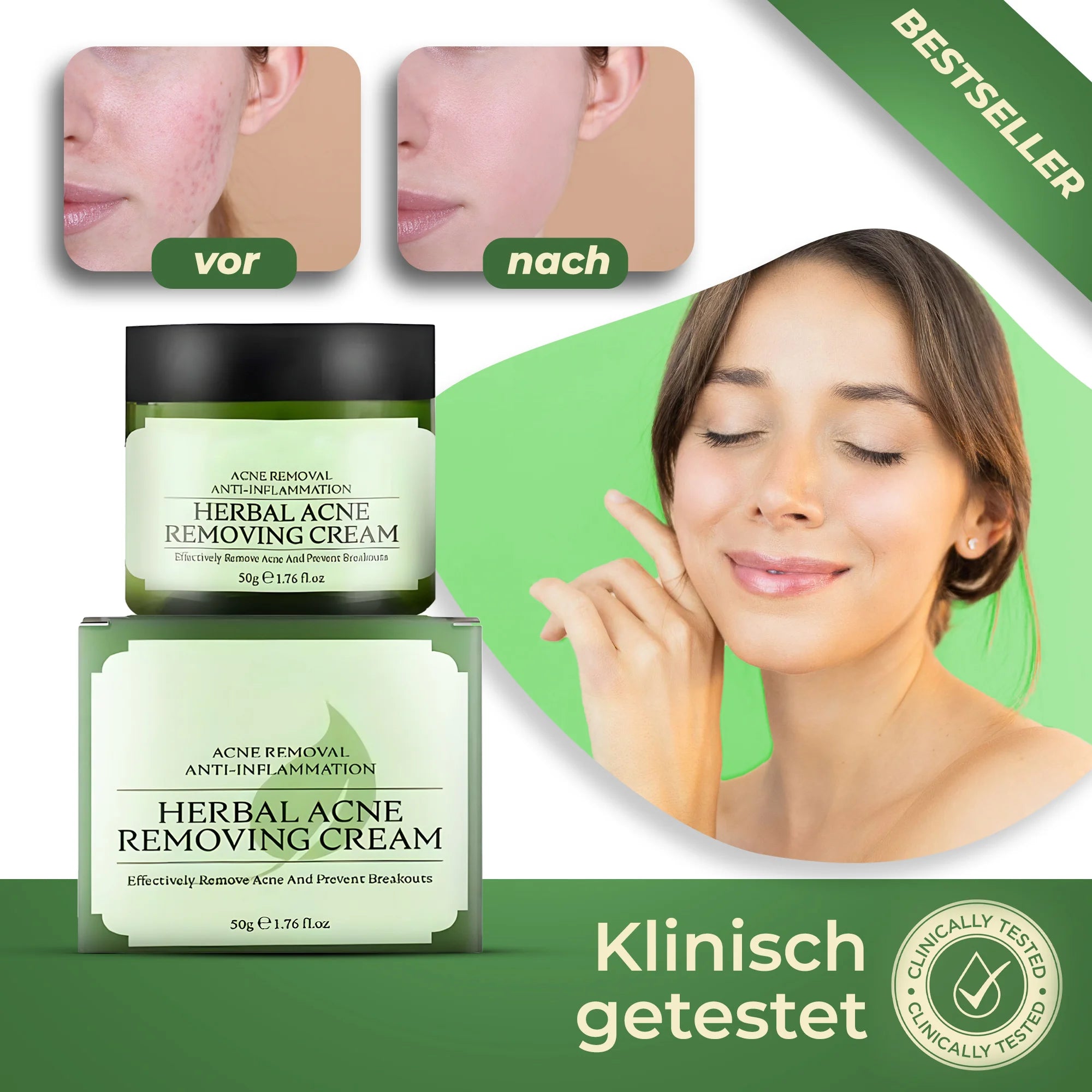 AcneGone™ - Creme | Beseitigt Akne zu 98% in 10 Tagen.