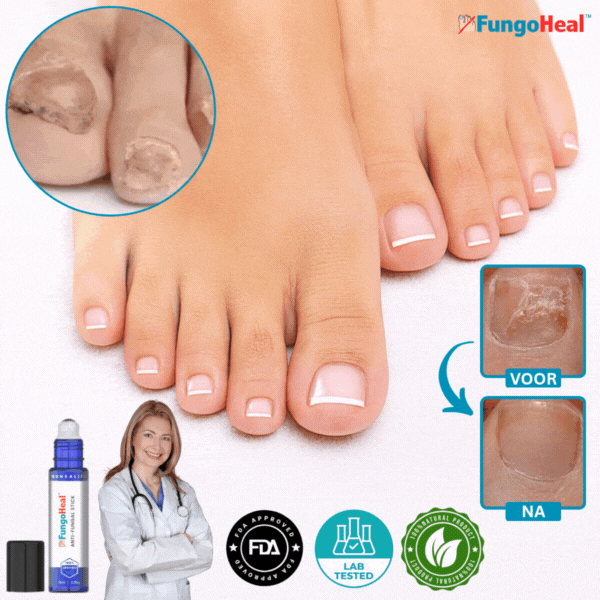 FungoHeal™ sagen | Nagelpilz entfernen und gesunde Nägel in 7 Tagen um 95 % wiederherstellen
