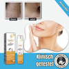 SkinClear™ - Spray | Entfernt Warzen und Hautflecken in 1-3 Wochen