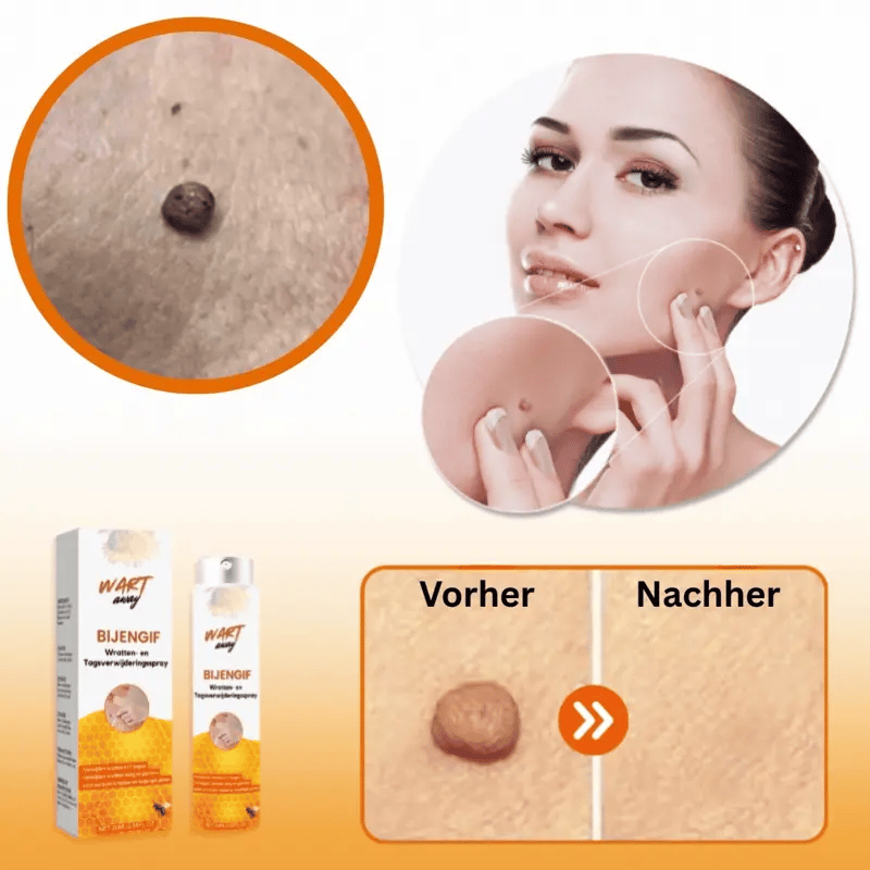 WartAway™ Warzen- und Fleckenentfernungsspray sagen | Entfernt alle Warzen und Hautflecken in 7 Tagen