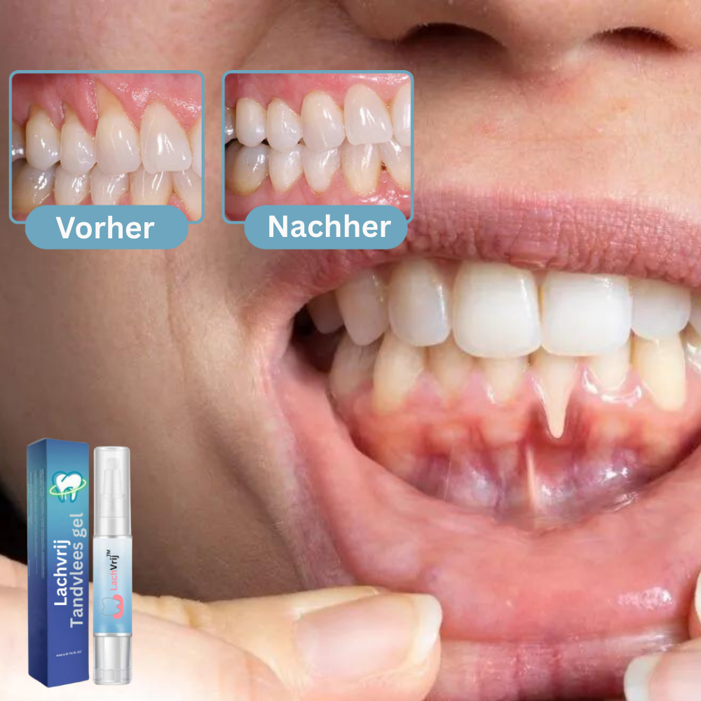 SmileFree™ Zahnfleischgel sagen | Kein Zahnfleischrückgang mehr nach 3 Tagen!