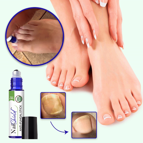 NailShield™ Antimykotikum-Stick | Verabschieden Sie sich in nur 5 Tagen von Nagelpilz!